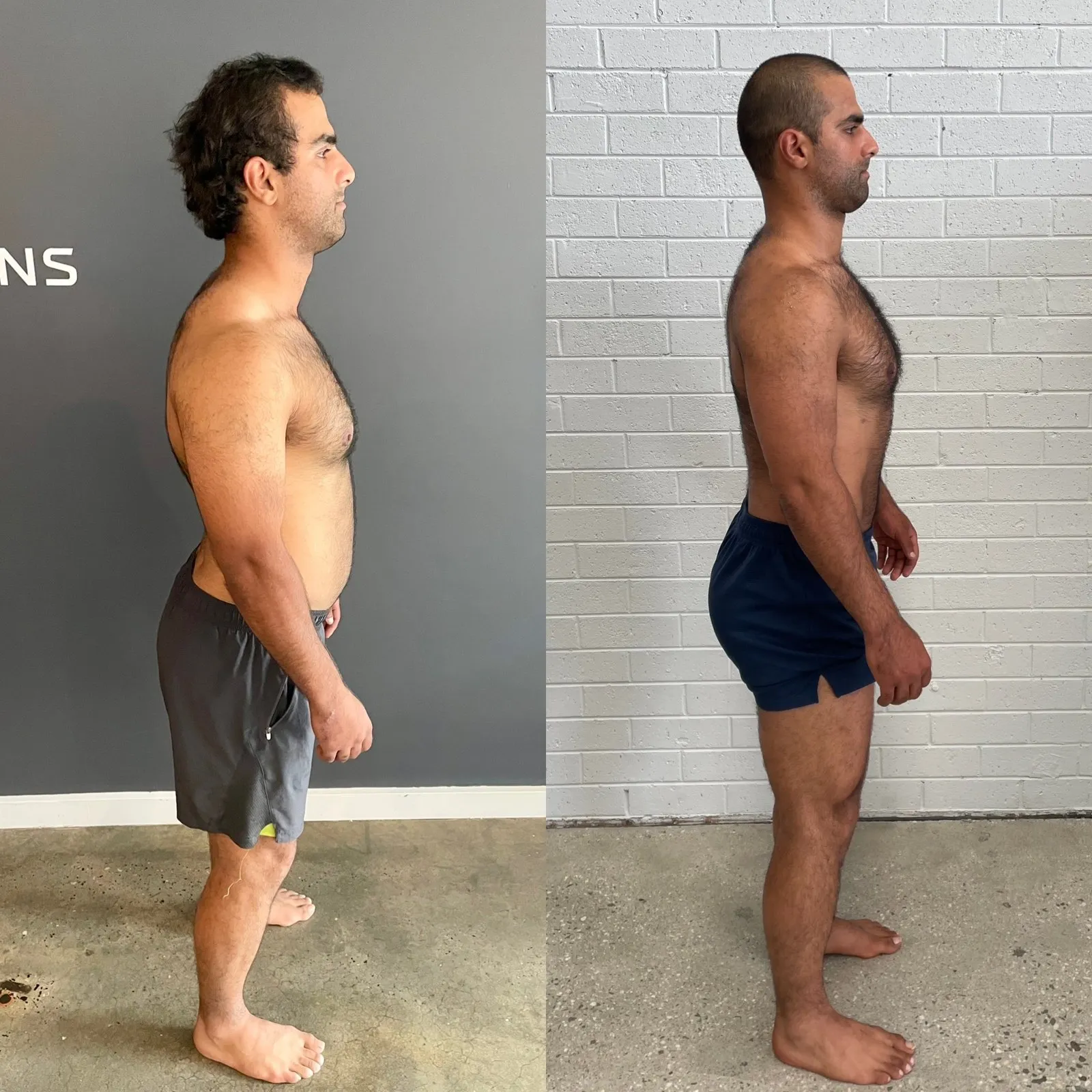 Albert before and after, side view